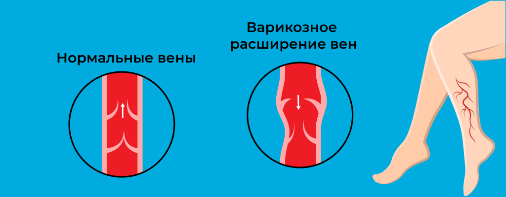 Варикоз_001 копия.jpg