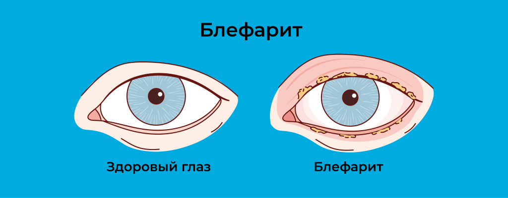 Блефарит_001 копия.png