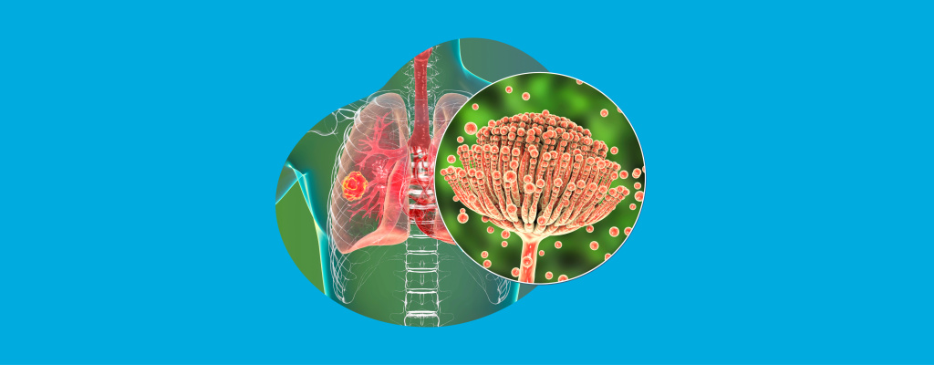 Аспергиллез легких_2050х800_статьи-4.jpg