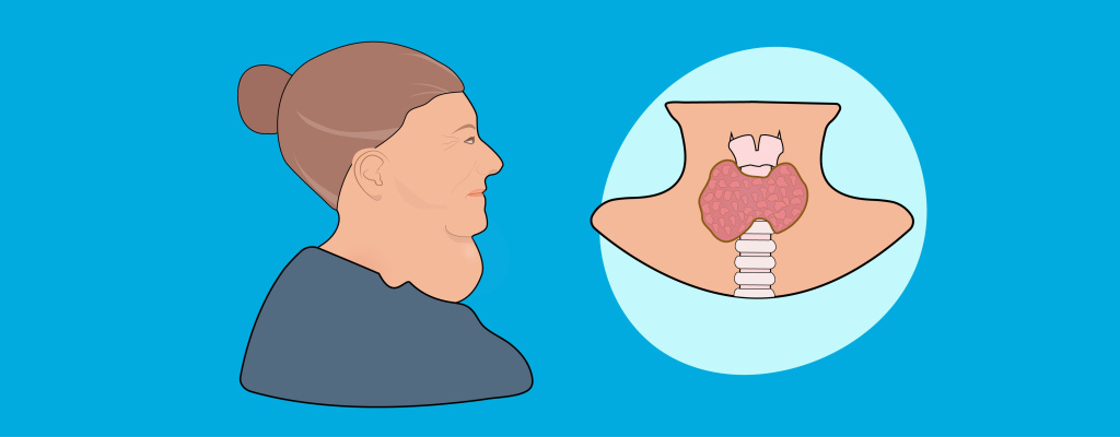 Базедова болезнь (Болезнь Грейвса)_001 копия.jpg