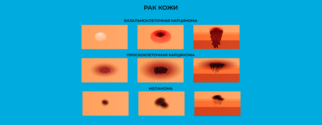Рак кожи_001 копия.png