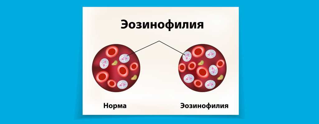 Эозинофилия_001 копия.jpg
