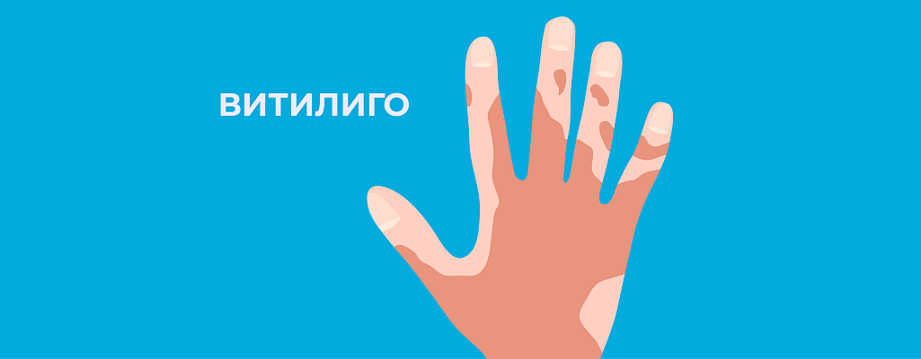 Витилиго