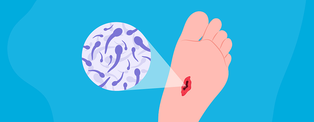 Столбняк: симптомы, лечение, профилактика