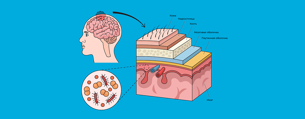 Менингит у детей