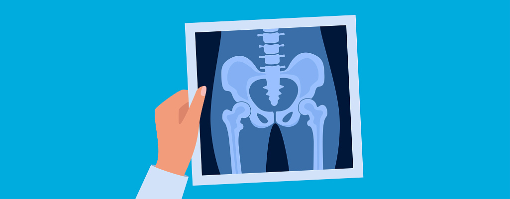 Коксартроз