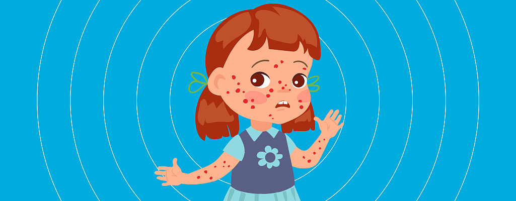 Холодовая крапивница (холодовая аллергия) — симптомы и лечение