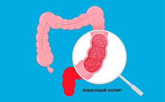 Язвенный колит (НЯК): что это, симптомы, лечение кишечника и диагностика