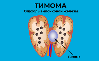 Тимома
