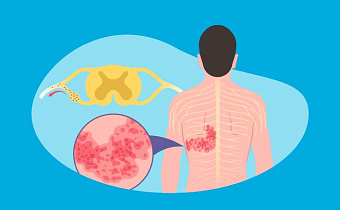 Опоясывающий лишай