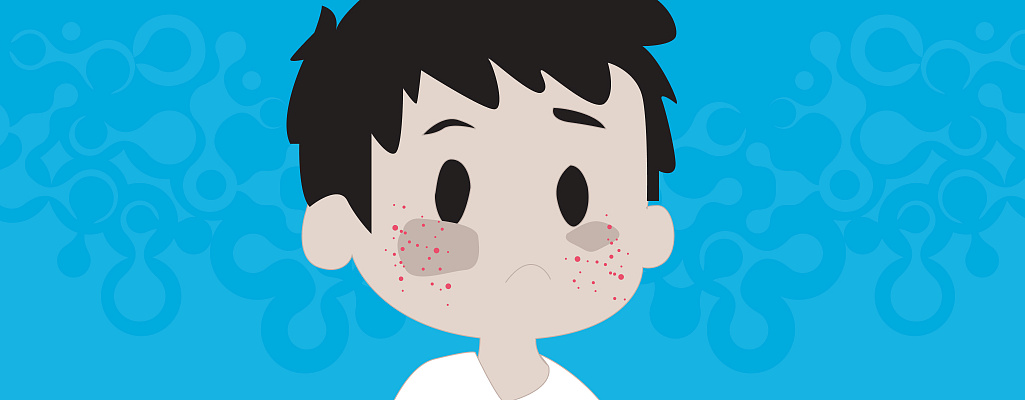 Крапивница