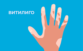 Витилиго