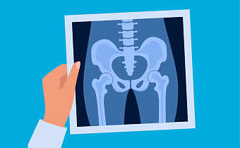 Коксартроз