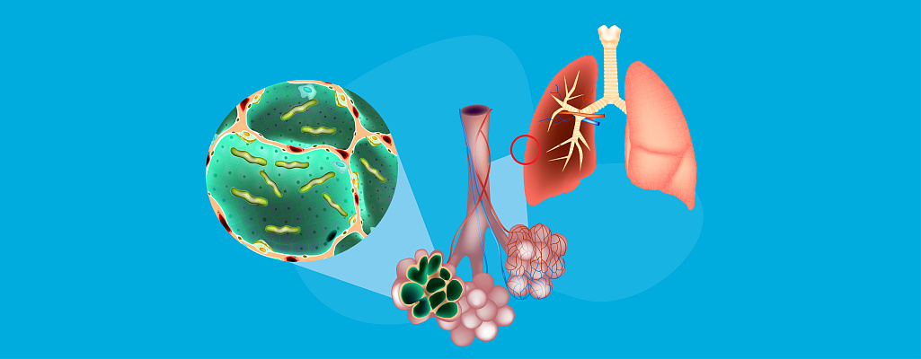 Пневмококковая инфекция