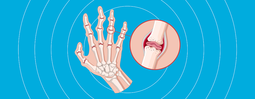 Аутоиммунные заболевания