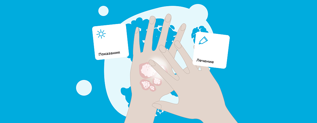 Псориаз (или чешуйчатый лишай)