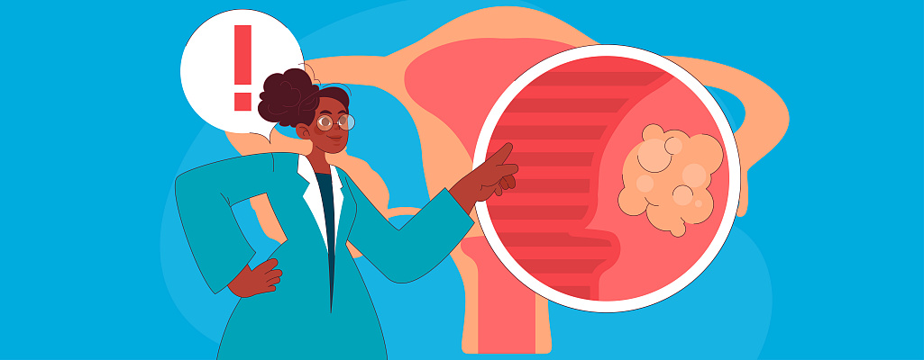 Миома матки