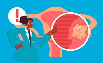 Миома матки