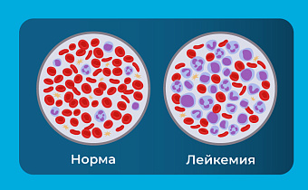 Лейкемия (Лейкоз): что это, рак крови, симптомы и острый лейкоз