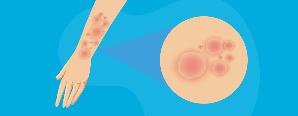 Розовый лишай у человека: симптомы, причины, лечение и отличия от других кожных заболеваний