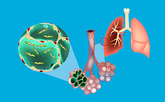 Пневмококковая инфекция