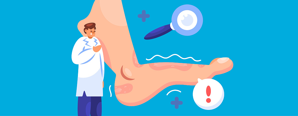 Аллергия на ногах: причины, признаки и что делать