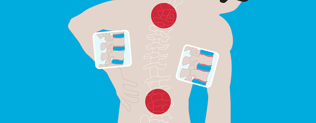 О болезни Бехтерева (анкилозирующем спондилоартрите)