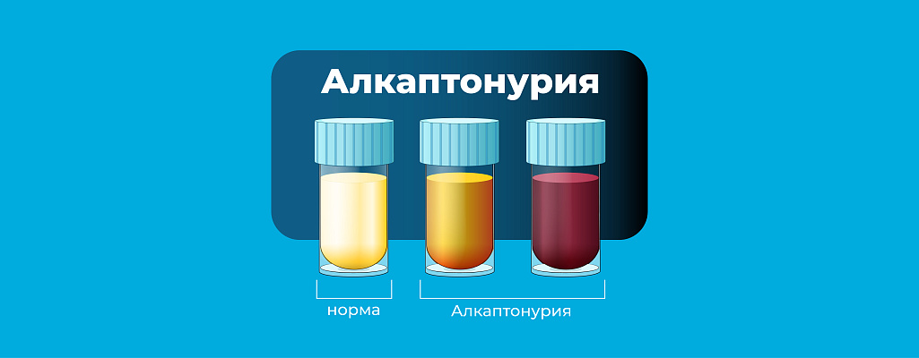 Алкаптонурия