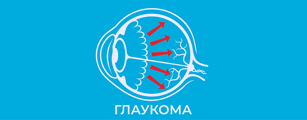 Глаукома: что это за болезнь, симптомы, причины и лечение