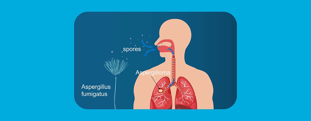 Аспергиллез