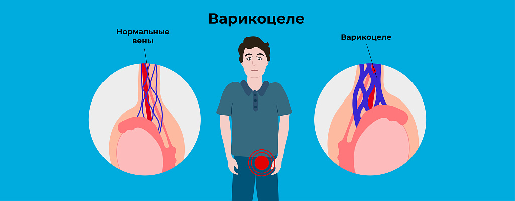 Варикоцеле у мужчин