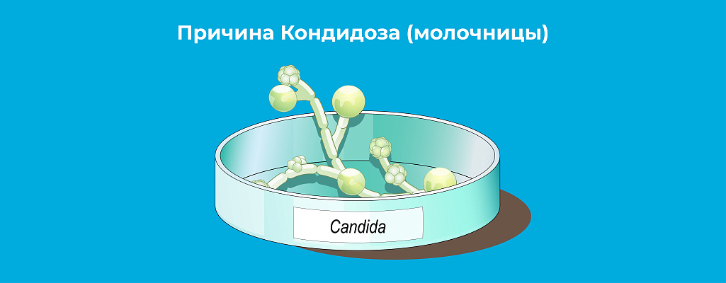 Кандидоз (молочница): симптомы, причины и лечение у мужчин и женщин