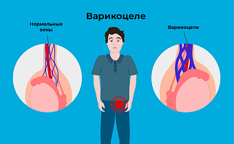 Варикоцеле у мужчин