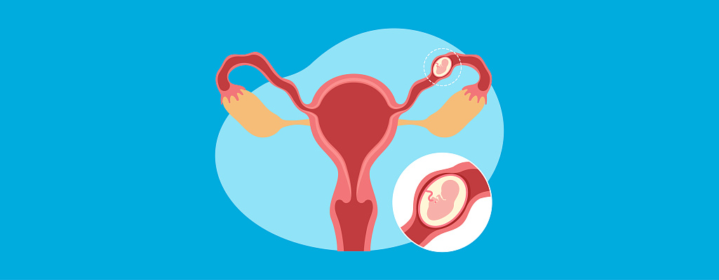 Внематочная беременность