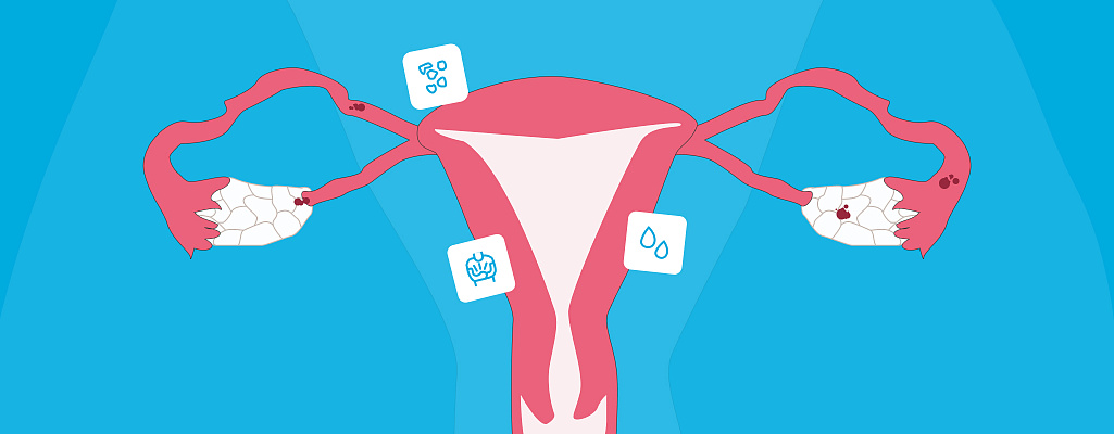 Эндометриоз