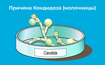 Кандидоз (молочница): симптомы, причины и лечение у мужчин и женщин