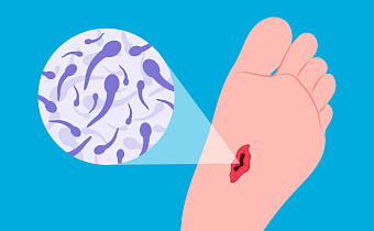 Столбняк: симптомы, лечение, профилактика