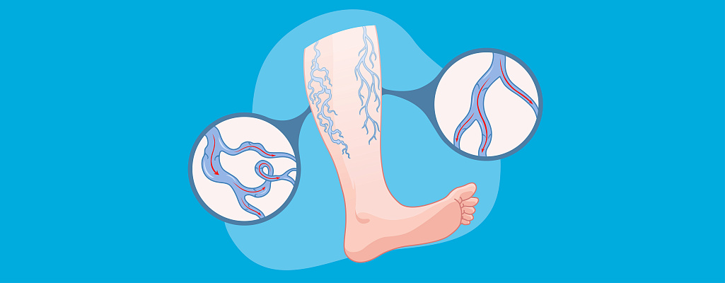 Варикоз вен на ногах: причины, симптомы и эффективные методы лечения у женщин и мужчин