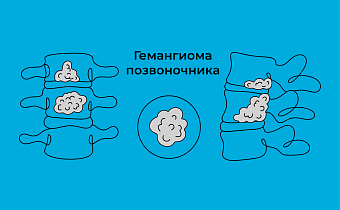 Гемангиома позвоночника: что это такое, симптомы, диагностика и лечение 