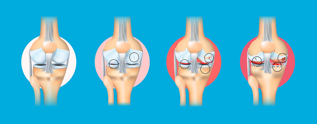 Остеоартрит (Остеоартроз)