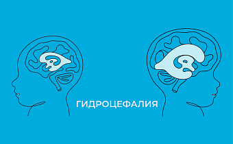 Гидроцефалия