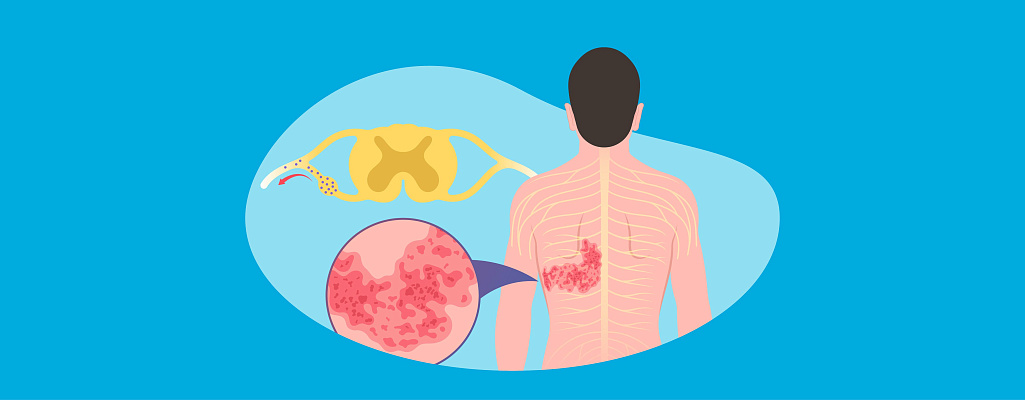 Опоясывающий лишай